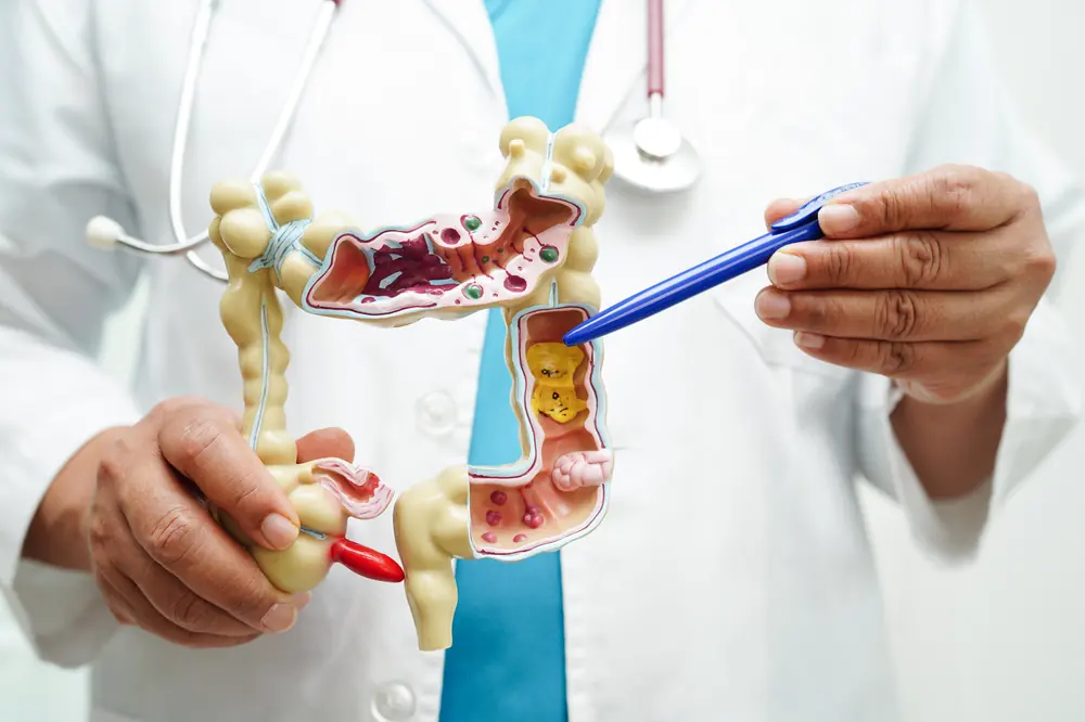 Colostomia e Ileostomia: O que São, Indicações e Como Cuidar